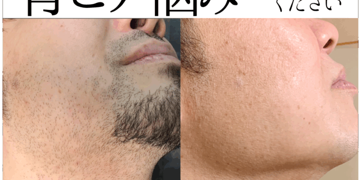 「青ヒゲ悩み お任せください」と書かれた、男性ヒゲ脱毛のビフォーアフター比較画像。Before画像は口周りから顎にかけて濃いヒゲが生えており青みが目立つ。After画像はヒゲが脱毛され、肌が滑らかで清潔感のある状態になっている。